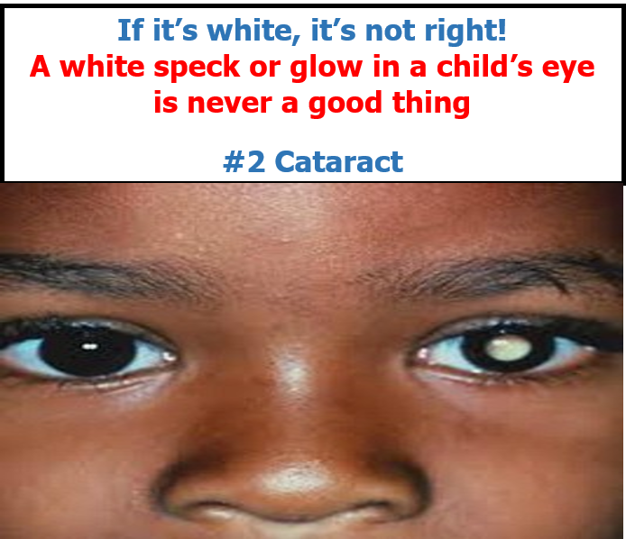 Childhood cataract - Can cataract affect children? || Eyehub Nigeria